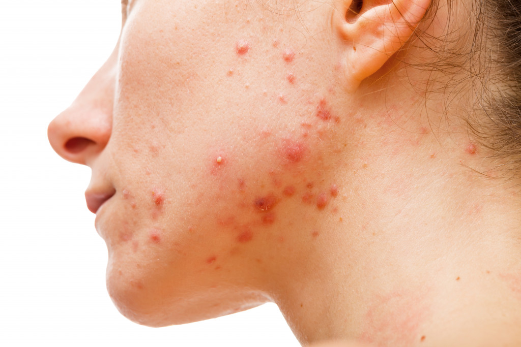 Skin allergies on woman